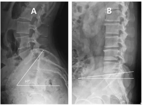 Fig. 8. Sacral Flexion and Extension Malpositions.