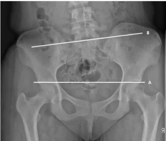 Fig. 9. Sacrum Lateral Flexion Malposition.