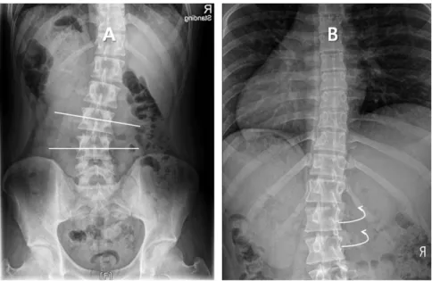 Fig. 2. Lateral Fexion and Rotation Malposition.