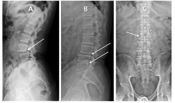 Fig. 3. Listhesis Malpostions.