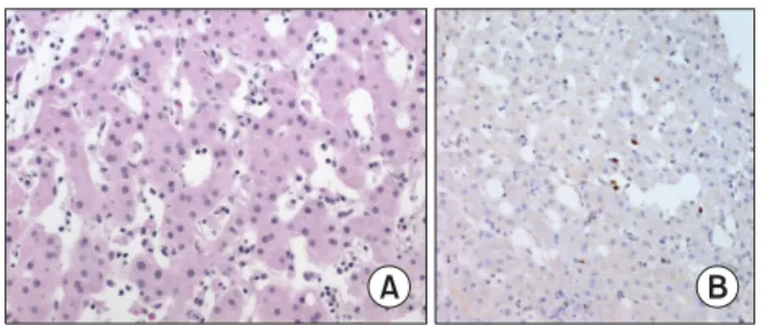 Fig. 1. (A) Chronic active EBV infection, T/NK cell. Liver biopsy shows minimal histologic change