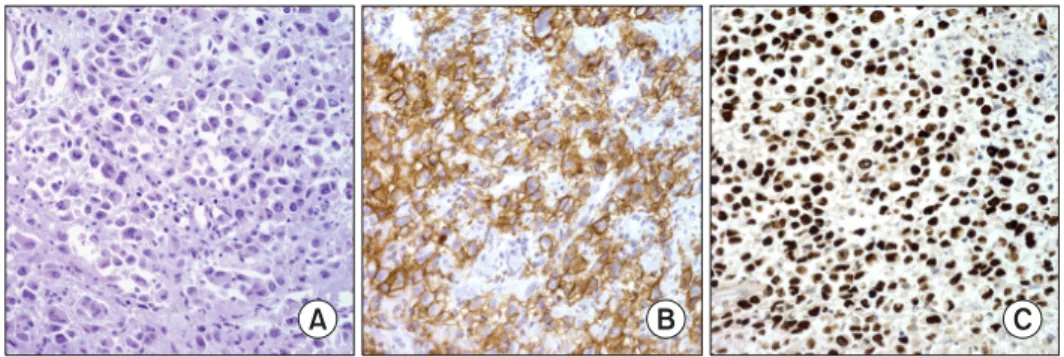 Fig. 5. (A) EBV-positive diffuse large B  cell  lymphoma,  not  otherwise  specified. Lymph node biopsy shows large  cell  lymphoma