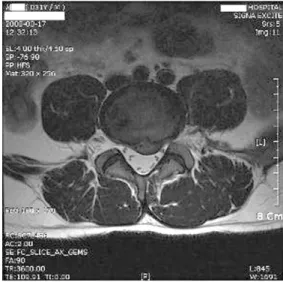Fig. 1. Sagittal Image of L-Spine MRI in Case 1 Fig. 2. L4/5 Axial Image of L-Spine MRI in Case1