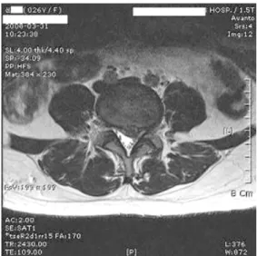 Fig. 5. L4/5 Axial Image of L-Spine MRI in Case 2 Fig. 6. L5/S1 Axial Image of L-Spine MRI in Case2