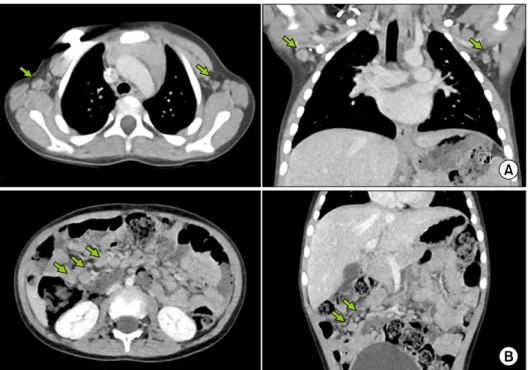 Fig. 1. Computed tomography scan showing  enlargement  of  axillary  (A) and abdominal (B) lymph nodes (indicated  with  green  arrows).