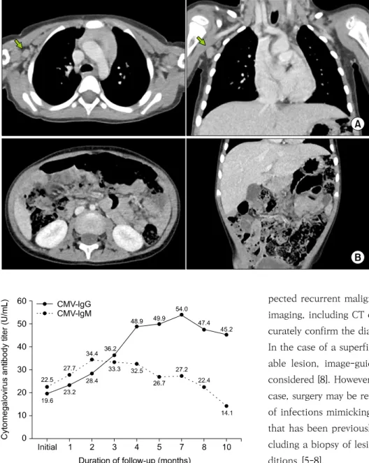 Fig. 3. Computed tomography scan at the 4-month follow-up showing  a decrease in the size and number of  axillary  (A)  and  abdominal  (B)  lymph  nodes  except  for  a  single  lymph  node  at  level  one  of  the  right  axillae  (indicated  with  green