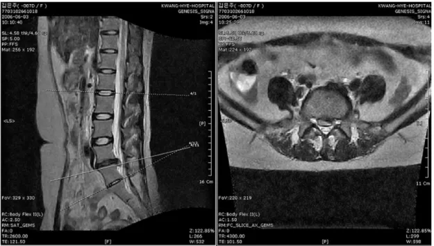 Fig. 11.  T2-weighted image of case 4 before treatment