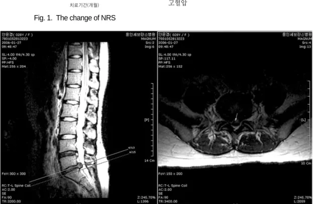 Fig. 1.  The change of NRS