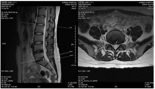 Fig. 3.  T2-weighted image of case 1 after treatment.