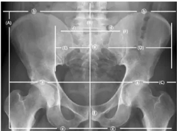 Fig. 1. X-ray Indicators of Sacroiliac Malposition.