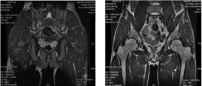 Fig. 1. Both hip coronal T2 weighted MRI.  Fig. 2. Both hip coronal T2 weighted MRI.