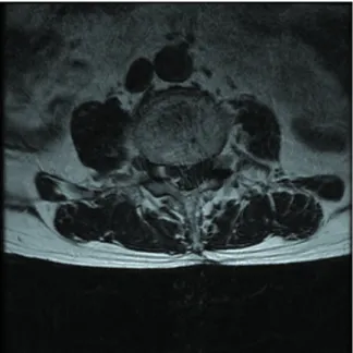 Fig. 1. Sagittal Image of L-spine MRI.  Fig. 2. Axial Image of L-spine MRI.