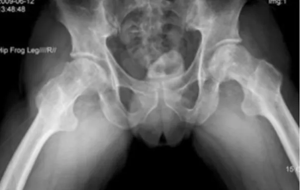 Fig. 1.  Hip joint X-ray (frog leg view)