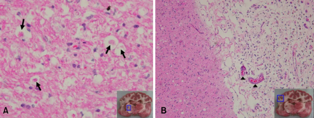 Fig. 4. Microscopic features of the brain in an experimentally embolized dog (ID 2). (A) Thalamic lesion