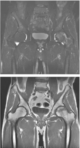 Table Ⅰ. ROM(range of motion) and Physical Exam of Lt. Hip Joint 11.04.26 Abduction 15 Adduction 20 Flexion 40 Extension 20 Patrick +