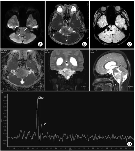 Fig. 1. Diffuse pontine glioma. Dif- Dif-fusion-weighted image (A) and  ap-parent diffusion coefficient map  (B) show a region with restricted  water diffusion (arrows) suggesting a higher-grade tumor