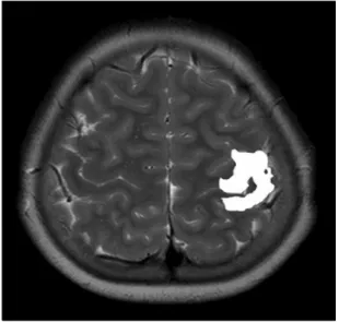 Fig. 3. Functional magnetic resonance imaging shows the left  motor area induced by a right finger tapping task.