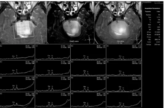Fig. 6. Diffuse pontine glioma. 