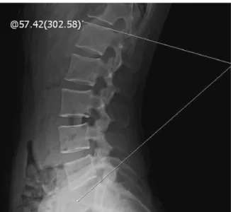 Fig. 1.  Measure of lumbar lordotic angle.