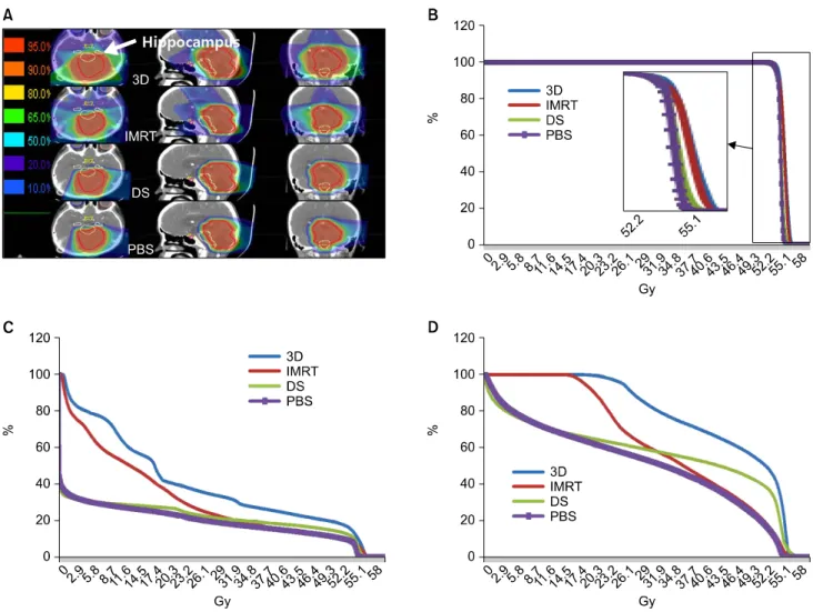 Fig. 2. (A) Treatment plan of 3D, IMRT, DS and PBS for 11-year-old boy with low grade glioma (Table 1, Case 4)