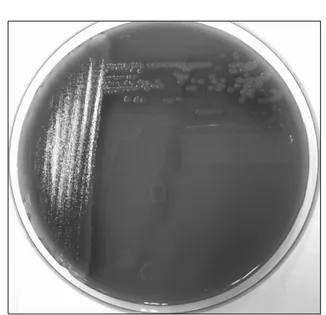 Fig. 2. Aspirated fluid from skin lesion inoculated blood agar  culture plate showing colonies of Klebsiella Pneumoniae