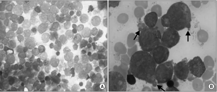 Fig. 1. Bone marrow smear at the time of diagnosis. (A) Magnification ×400, Wright-Giemsa staining, (B) Cytoplasmic blebs (arrows) are demonstrated on the surface of several blasts