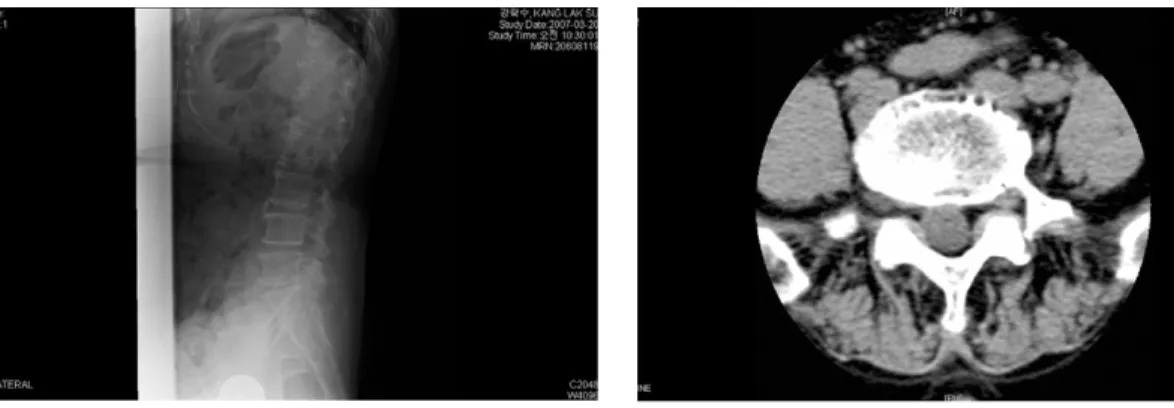 Fig. 1.  L spine lateral view Fig. 2.  Lumbar spine ct