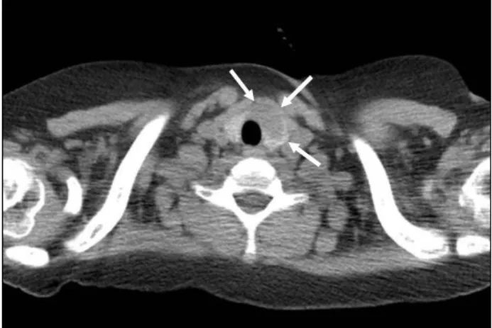 Fig. 1. Chest computed tomogram revealed an incidental thyroid  mass sized 2.5×1.3 cm (arrows) in the left lobe of the thyroid  gland