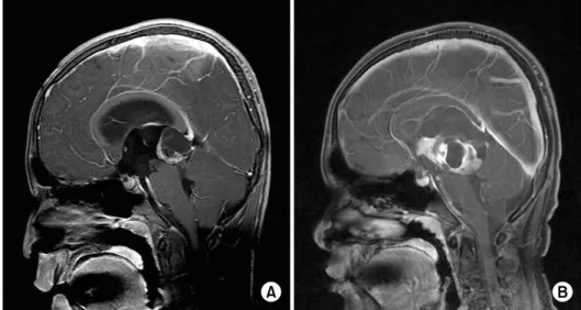 Fig. 1. (A) At diagnosis, MRI demon- demon-strates a 3×2.7×2.5 cm cystic and solid mass in the pineal gland with obstructive hydrocephalus