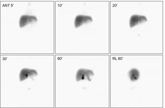 Fig. 3. PB smear (A) and bone marrow aspirate smear (B) showed that markedly increased variable sized lymphoblasts which has  round or indented nucleus with nucleoli and scanty cytoplasm were seen