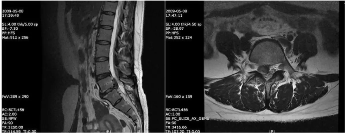 Fig. 1.  T2-weighted image of case 1 before treatment.