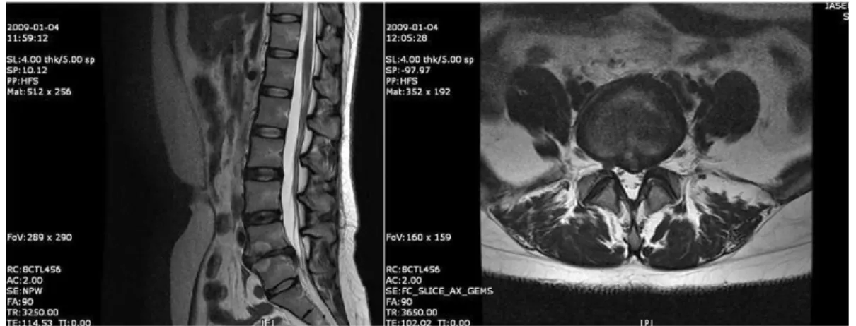 Fig. 3.  T2-weighted image of case 1 before treatment.