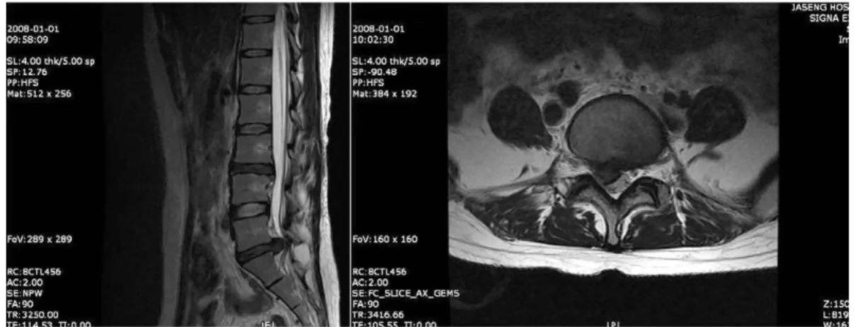 Fig. 6.  T2-weighted image of case 1 after treatment.