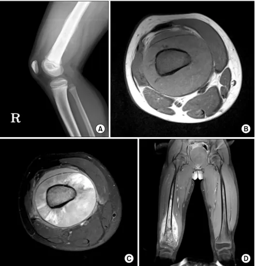 Fig. 1. (A) A simple X-ray film image, (B) axial image on MRI scan, T1-  weighted image, (C) T2-weighted  image and (D) coronal image,  contrast-enhanced T1-weighted image.