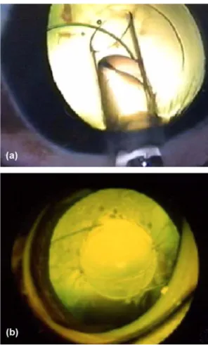Fig. 1.  Photograph of the IOL placement and pseudophakic eye after phacoemulsification