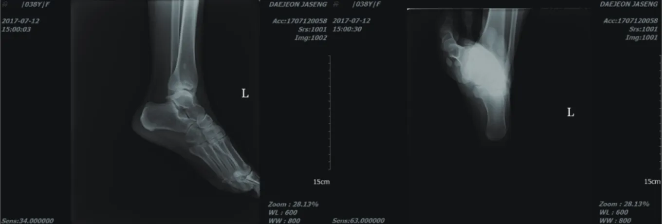Fig. 2. Lt Calcaneus Lateral &amp; Axial view(2017-07-12).