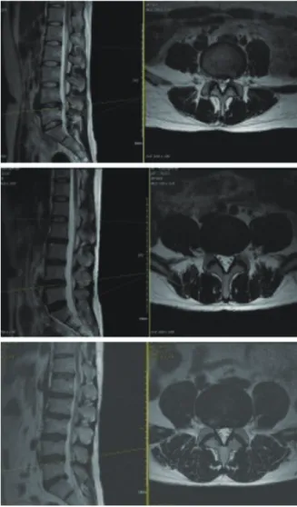 Fig. 1. T2 weighted sagittal and axial view of Case 1,2,3. Level L4-L5.
