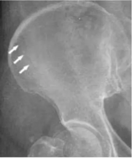 Fig. 2.  Bone Scan (2009.06.04)Fig. 1.  Pelvis AP (2009.06.03)