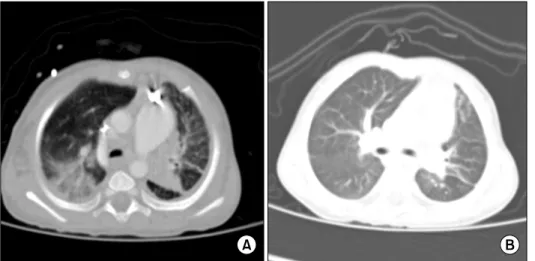 Fig. 1. (A) Chest CT, suggested  invasive pulmonary aspergillosis,  before allogeneic HSCT