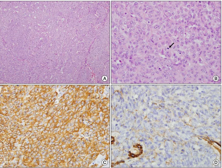 Fig. 2. Photomicrography of a malignant glomus tumor. (A) Solid sheets or trabeculae of tumor cells along with a prominent thin-walled vascular network (H&amp;E ×100)