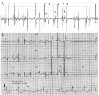Fig. 1. Cardiac phonocardiogram (A) and electroncardiogram (B).