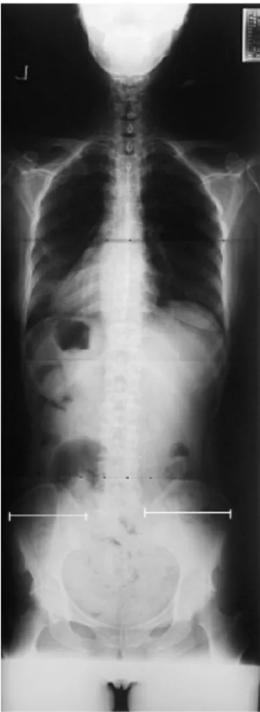 Fig. 9.  Full spine AP X-ray performed at 2010- 2010-06-15. 