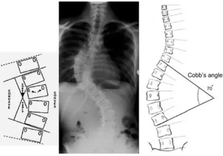 Fig. 2.  Cobb’s angle.