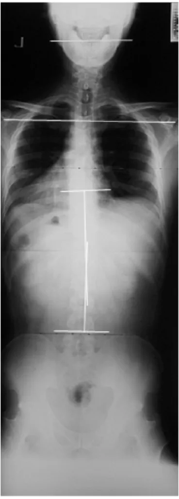 Fig. 3.  Full spine AP X-ray performed at 2010- 2010-08-24. 