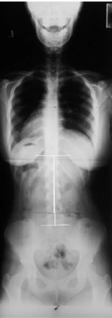 Fig. 6.  Full spine AP X-ray performed at 2010- 2010-06-17. 