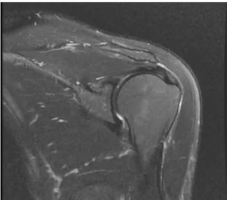 Fig. 1. Left shoulder MRI(Coronal T2 fat suppressed FSE).