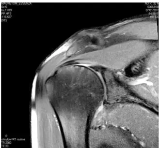 Table Ⅳ. The Improvement of Shoulder ROM and Pain