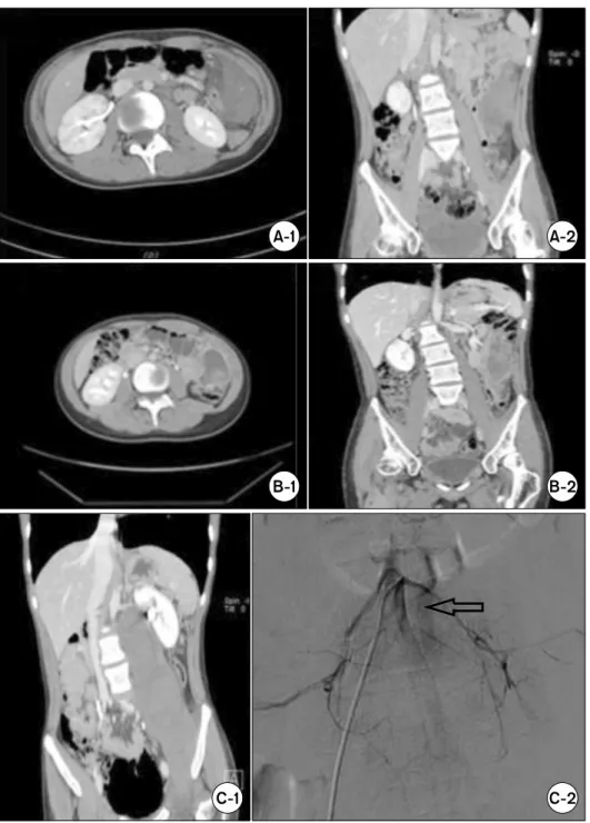 Fig. 1. Computed tomography (CT) scans of the abdomen and pelvis  showing a large hematoma in the  left side of the abdomen in a  15-year-old boy