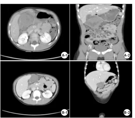 Fig. 2. Computed tomography (CT) scan of the abdomen and pelvis  showing an intra-abdominal  he-matoma in a 6-year-old boy