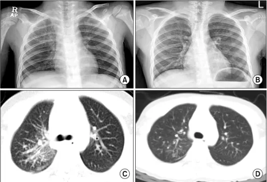 Fig. 1. Chest radiograph shows  reticular opacities in right lungs  before treatment (A)